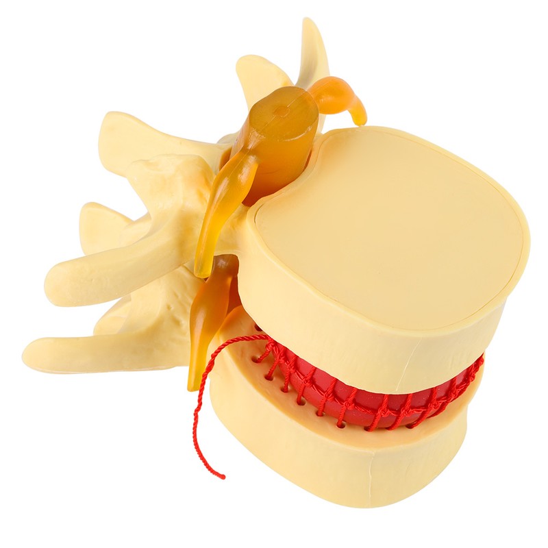 1:1.5 Anatomical Medical Human Spine Lumbar Disc Herniation Demonstration Model