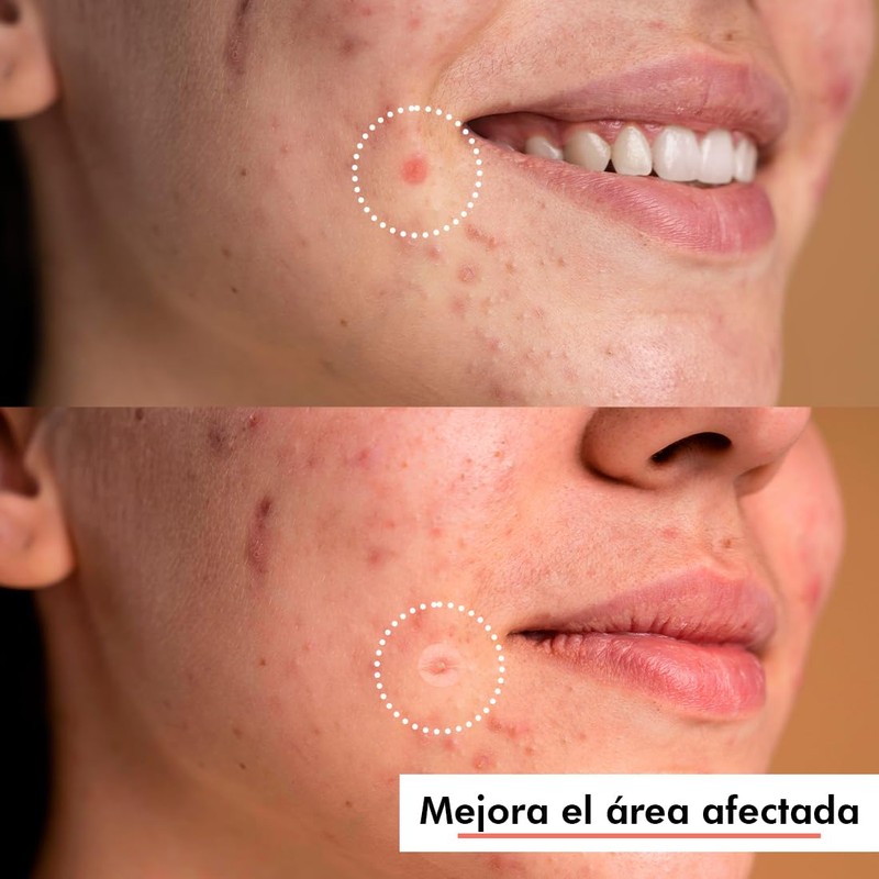Simple Pimple - Pickelpflaster, Pimple Patches mit Salicylsäure, Teebaumöl, Akne,