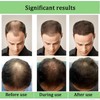 Alphainfuse Hair Regrowth System – Advanced Hair Growth Treatment with