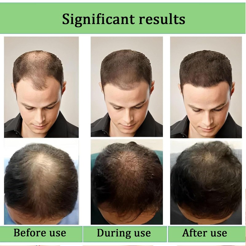 Alphainfuse Hair Regrowth System – Advanced Hair Growth Treatment with