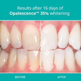 Opalescence Opalescence 35% PF Teeth (4 Syringes) Whitening Refill Kit Carbamide Peroxide. Made by Ultradent. Tooth Whitening Refill Syringes Unflavored A-5197-2