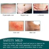 3 Meters Silicone Scar Stickers to Reduce Itching and Redness