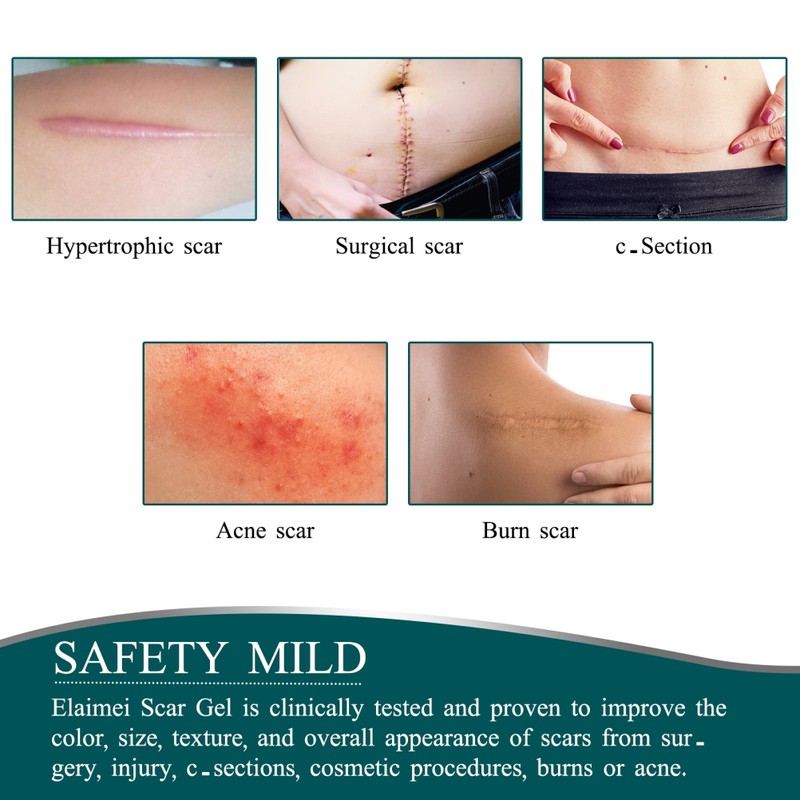 3 Meters Silicone Scar Stickers to Reduce Itching and Redness