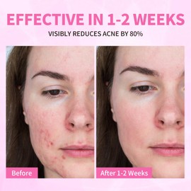 LXSKN Acne Serum for Face, Back and Body, Gentle Skin Care for Acne Prone Sensitive Skin | For Women & Men