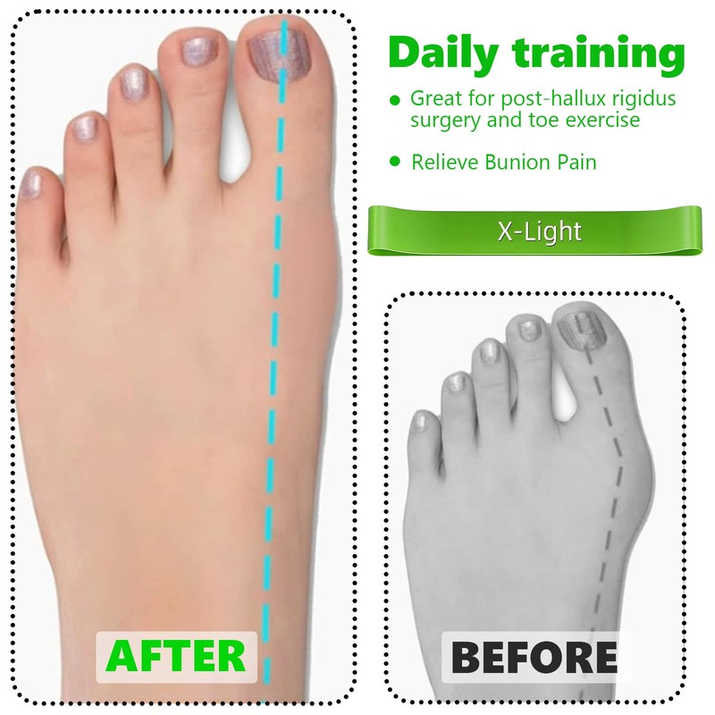 5 Pcs Latex Toe Stretch Bands with Storage Bag, Hallux