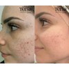 Crema Despigmentante Quita Manchas Acné Paño Vitíligo 30g Todo Tipo