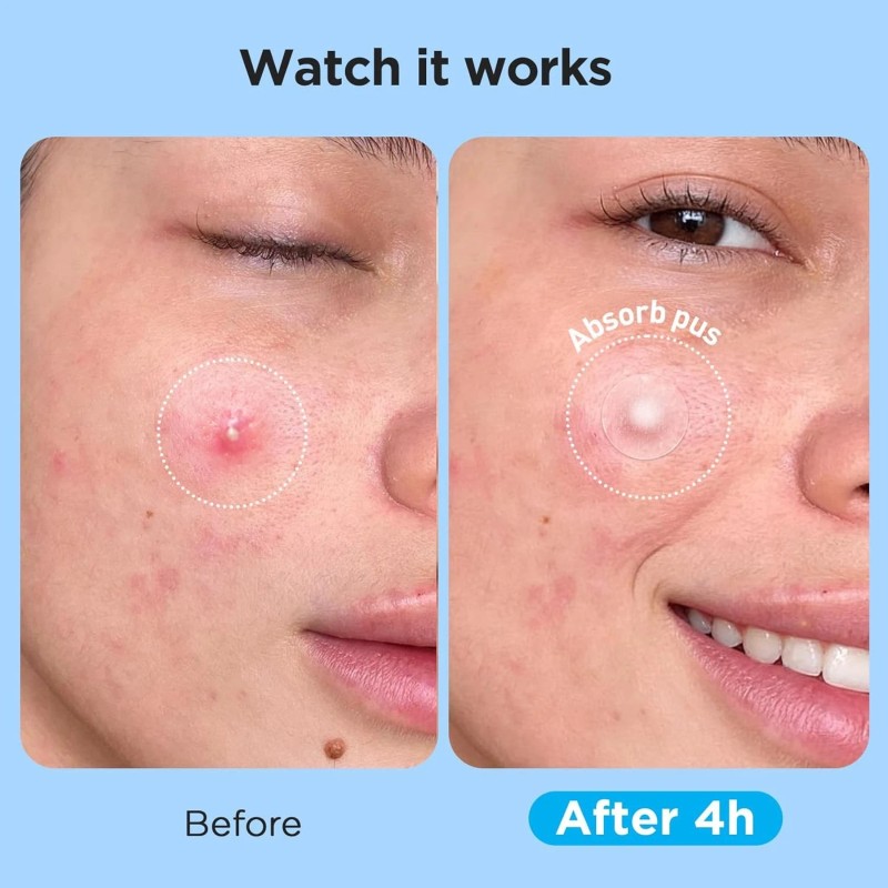 COSRX 24EA2 Acne Pimple Master Patch Sheets