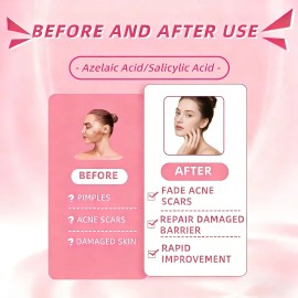 Acne Buster Loción Secante Con Ácido Salicílico 2pcs Todo Tipo De Piel Día/noche