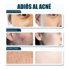 Crema De Anti Acne Reducir El Acné Rojizo 20g