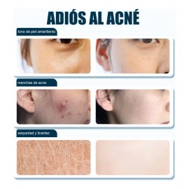 Crema De Anti Acne Reducir El Acné Rojizo 20g