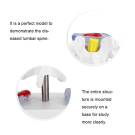 Human Size Medical Model - Anatomical Herniated Disc Demonstration Accessories for School Training, Spine, Nature Study on Wheels, Teaching Chart for Opening