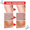 Professional Scar Removal Gel – Effective Treatment for Post-Operative, C-Section,