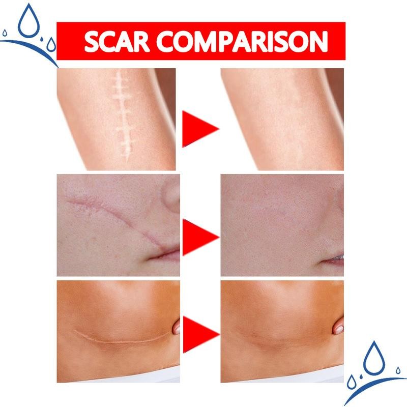 Professional Scar Removal Gel – Effective Treatment for Post-Operative, C-Section,