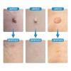 Elimina Mezquinos Granos Lunares Verrugas Manchas Vph