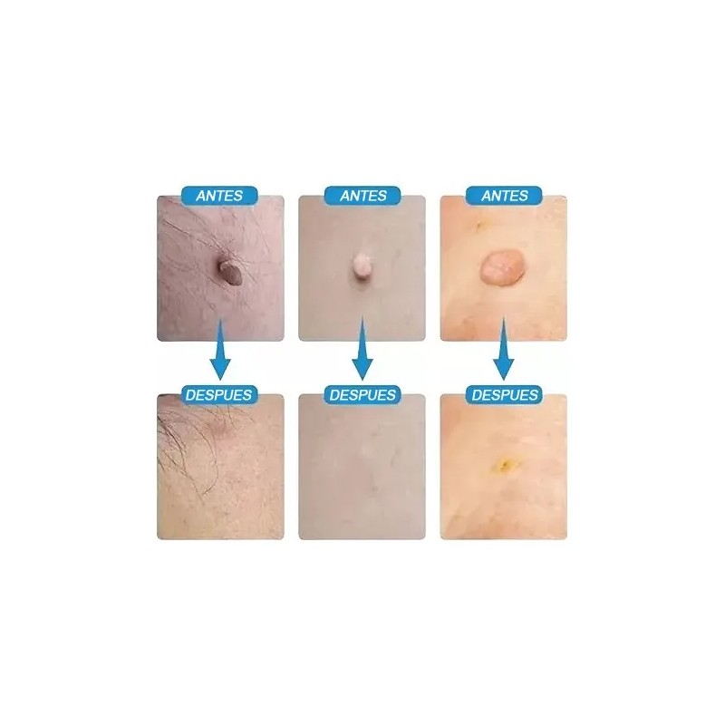 Elimina Mezquinos Granos Lunares Verrugas Manchas Vph