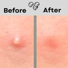 WeOura Pimple Patches- Pack of 48 Translucent Hydrocolloid Spot Patch