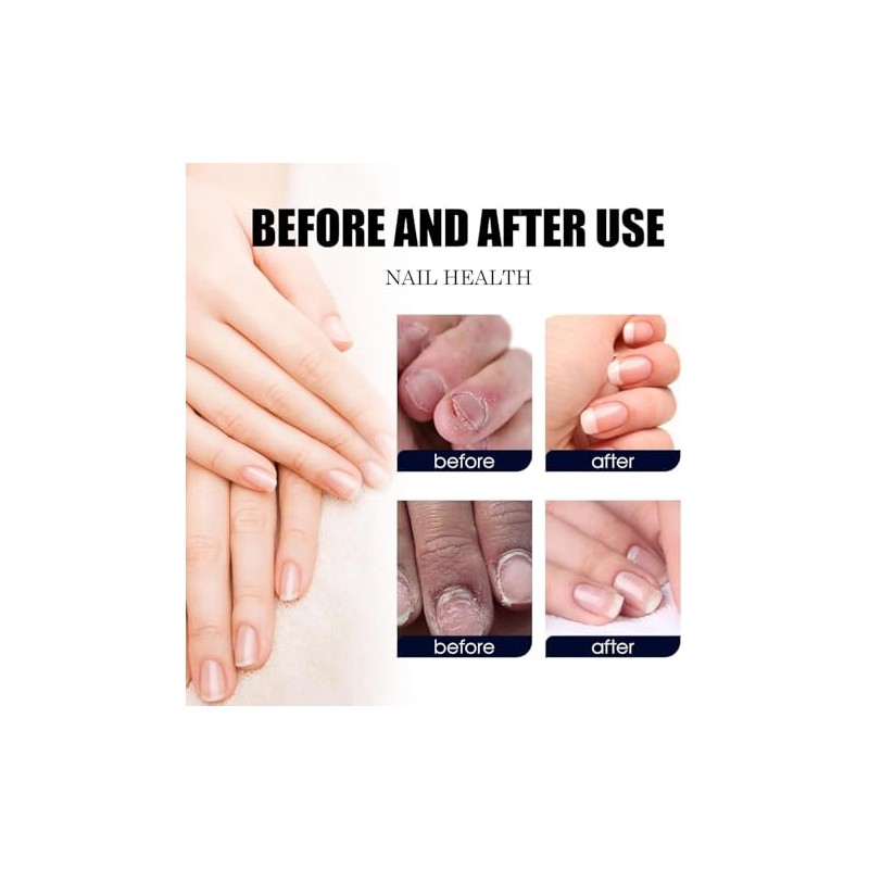 Ginger Nail, Tratamiento de Uñas con Jengibre, Soporte para Uñas,