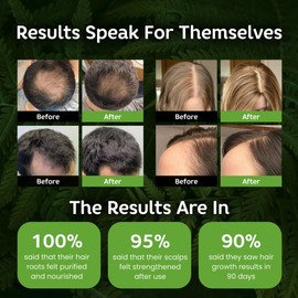 Rosemary & Biotin Hair Growth Shampoo for Women & Men, Natural Thickening & Regrowth Formula, Tea Tree Mint Strengthening Shampoo with Castor Oil - For Thinning Hair, Hair Loss, All Hair Types 10.1 Oz