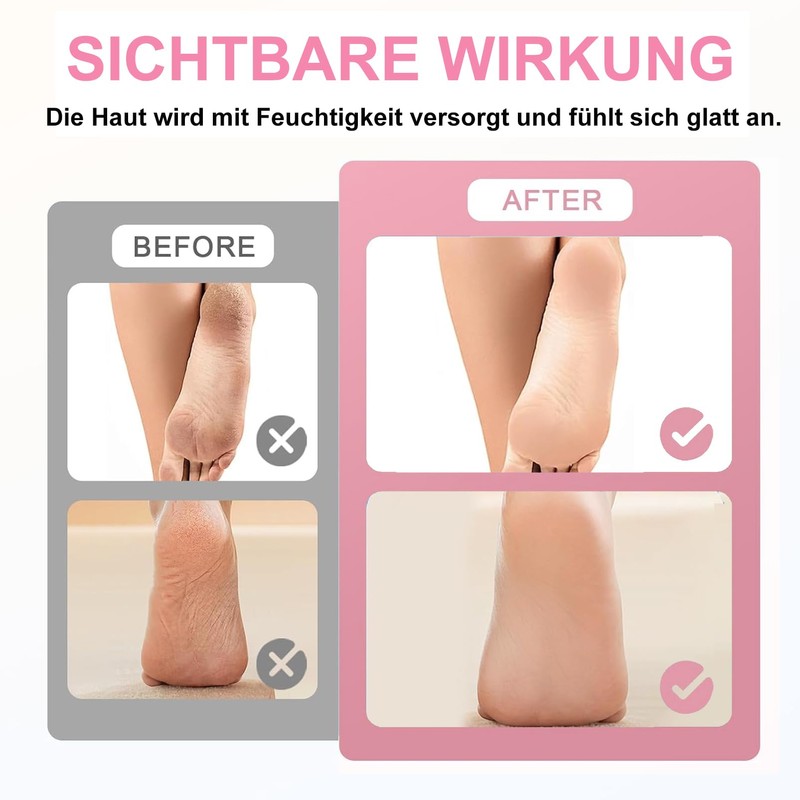 Urea Foot Cream 60%, Anti-Cracking Urea Cream, Foot Cream Very