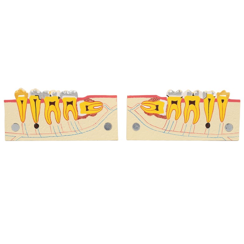 Right Lower Posterior Tooth Model 2X Magnification Detachable Resin Tooth