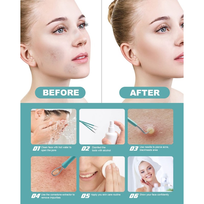 BEZOX Blackhead Remover Tool Kit - Pore Extractor Tools for