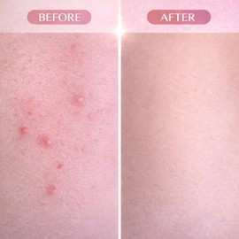 Cyperus Rotundus Serum Roll-On,Aceite de Cyperus Rotundus Natural para Reducir la Aparición del Vello, Hidratante y Calmante con Rosa Mosqueta, Jojoba y Té de Árbol, 30ml (2PC)