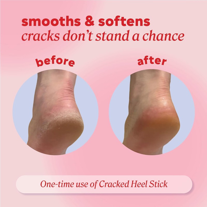 YUAKUOD Onyx Professional Cracked Heel Stick 2 Pack, Treatment Balm