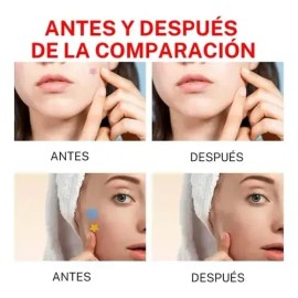 144 Parche Adhesivos Para Imperfecciones Piel Acné Verrugas