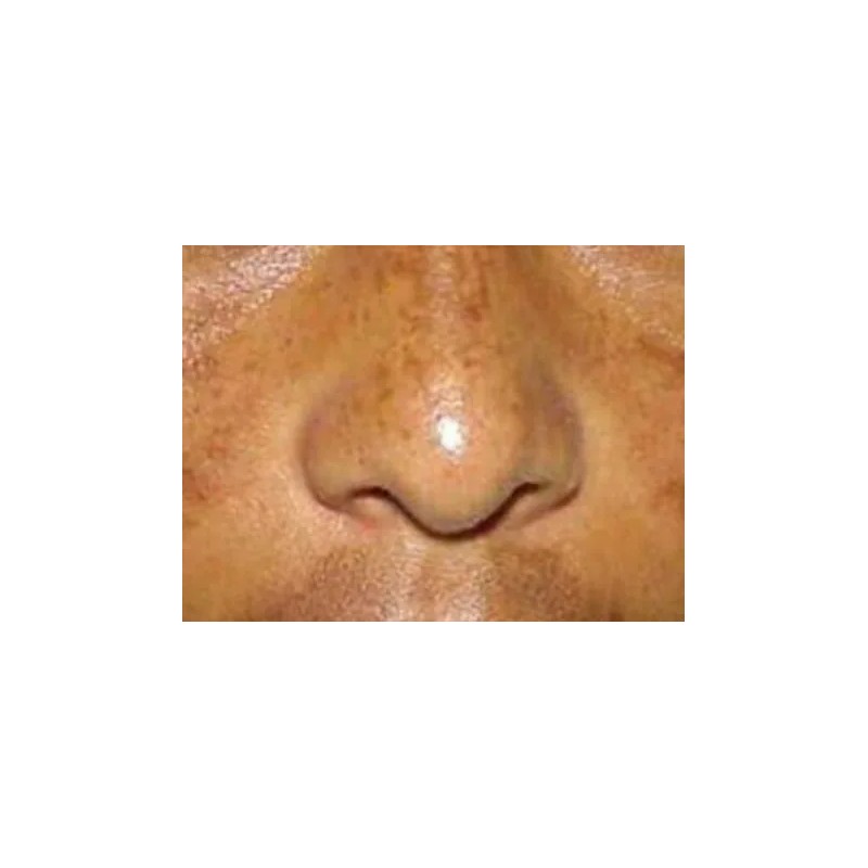 Crema Y Loción Elimina Manchas Paño Acne Sol Contaminación