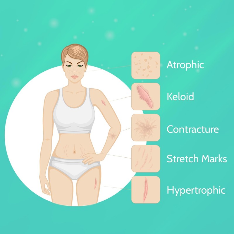 Wewell Crema de silicona para cicatrices y queloides – elimina