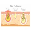 Hit The Spot Cleansing Chin & Forehead Pore Strips with