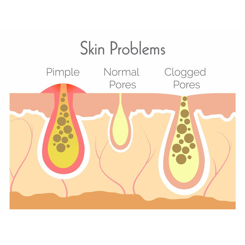 Hit The Spot Cleansing Chin & Forehead Pore Strips with