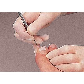 4x Nagelfalztamponade Copoline, Kosmetex Tamponade für Nägel-Nagelfalz, Tamponadebinde 1cm breit, 4x Tamponade