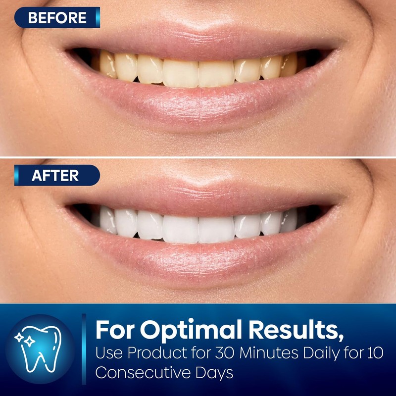 Teeth Whitening Strips – Non-Sensitive Teeth Whitening Stickers, 10 Packs