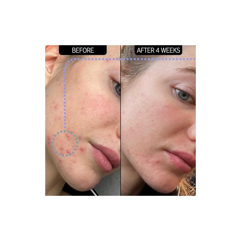 The INKEY List SuperSolutions Novoretin 2% Moisturizer, Skin Clearing Moisturizer