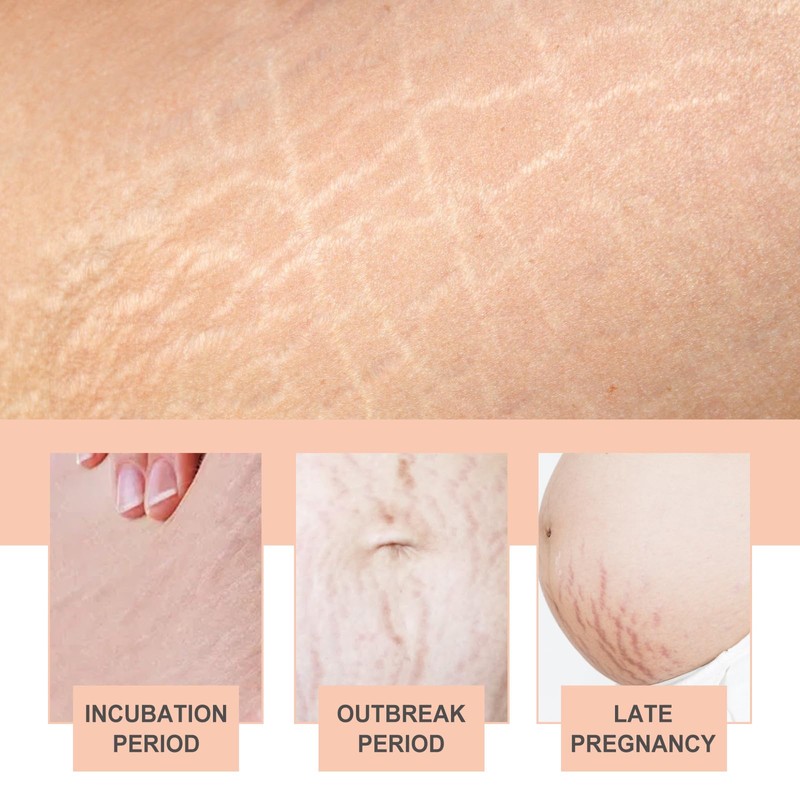 Silicone Patches for Stretch Marks, Anti Wrinkle Stretch Removal Sheet