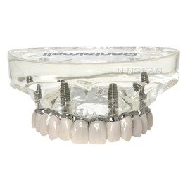 Dental Implant Model,Implant All on 4 Overdenture Treatment Model, Upper Jaw 4 Implants，Bridge with Titanium，Transparent Base (All on 4 Titanium Bridge Model, Clear)