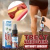 Complete Varicose Veins Care System: Spray, Cream, and Patches by Veinhealing
