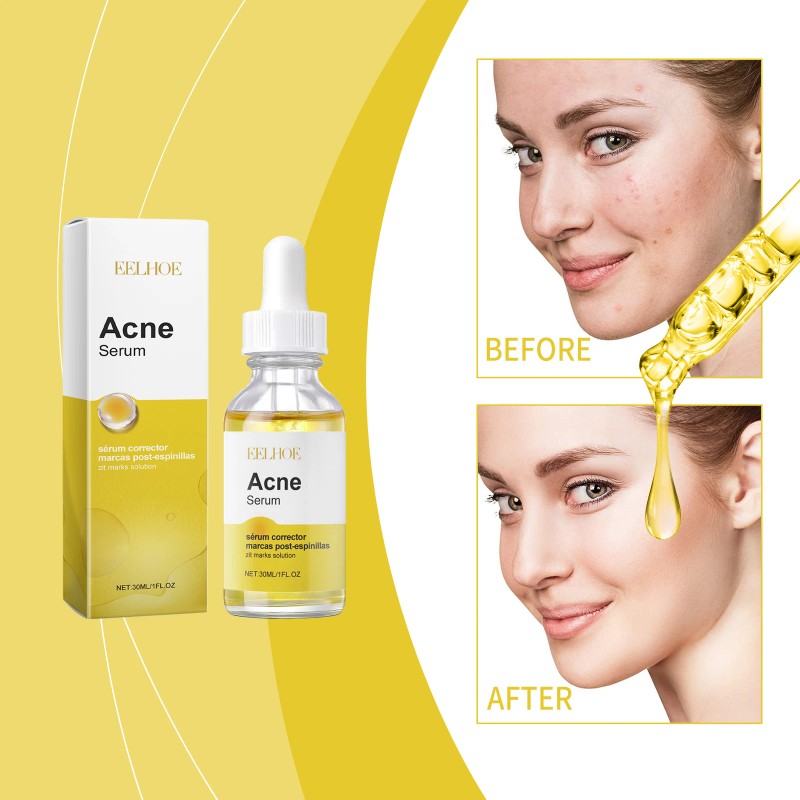 EELHOE Facial Acne Cleansing Essence Gentle Skin Repair for Acne-Prone