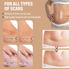 25 Stück Scar Tape,4cm*15cm Silikonpflaster,Silikon Narbenpflaster,Wiederverwendbares Silikonpflaster Für Narben,Für Operationsnarben,Kaiserschnitte