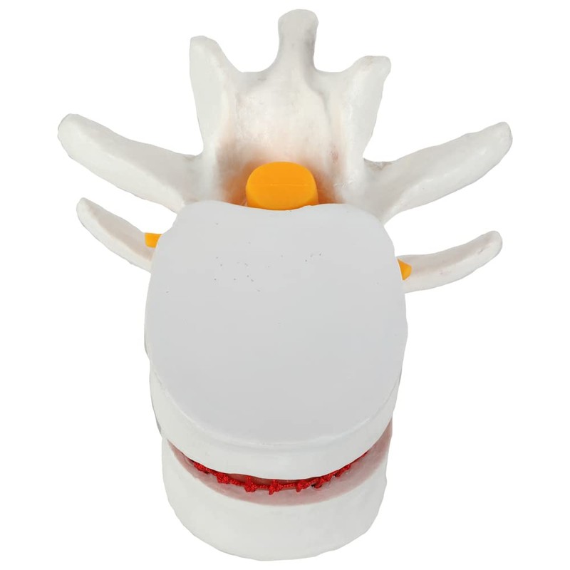 Axis Scientific Human Lumbar Herniating Disc Demonstration Anatomy Model for
