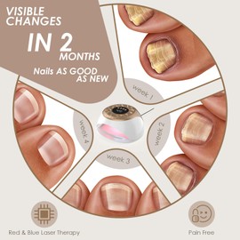 Nail Fungus Laser Upgrade Therapy Device,with Adjustable Sessions of 3/5/7/10 Minutes,Nail Laser Cleaning Fingernails & Onychomycosis,Nail Fungus Remover with 15*470nm Blue Light+42*650nm Red Light