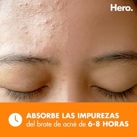 Hero Parches para Acné Mighty Patch Surface, Caja con 10 piezas. Tamaño XL para Brotes de Acné en Áreas Más Grandes. Absorbe las Impurezas, No Contiene Medicamento y Probados Dermatológicamente