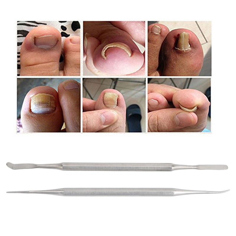 10pcs 13mm Ingrown Toenail Corrector Stainless Steel Ingrown Toe Wire