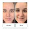 Replenix Acne Solutions Gly-Sal 5-2 Exfoliating Acne Pads with Glycolic