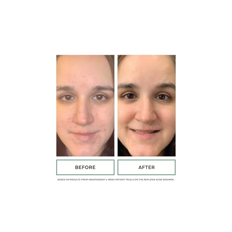 Replenix Acne Solutions Gly-Sal 5-2 Exfoliating Acne Pads with Glycolic