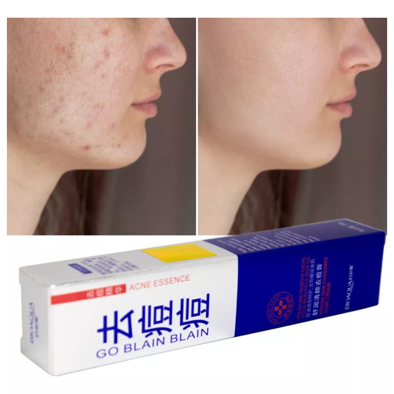 ANTI- ACNÉ Anti Acne Crema Cicatrices Cacarizos Grasa Tratamiento Piel