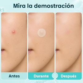 360 Parches Para Acn.Pimple Patch, Parches para Espinillas, Cubrir Imperfecciones, para Todos Los Tipos de Piel                                       