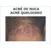 Boxi Tratamiento Para Acné Queloideo De Nuca 120 G