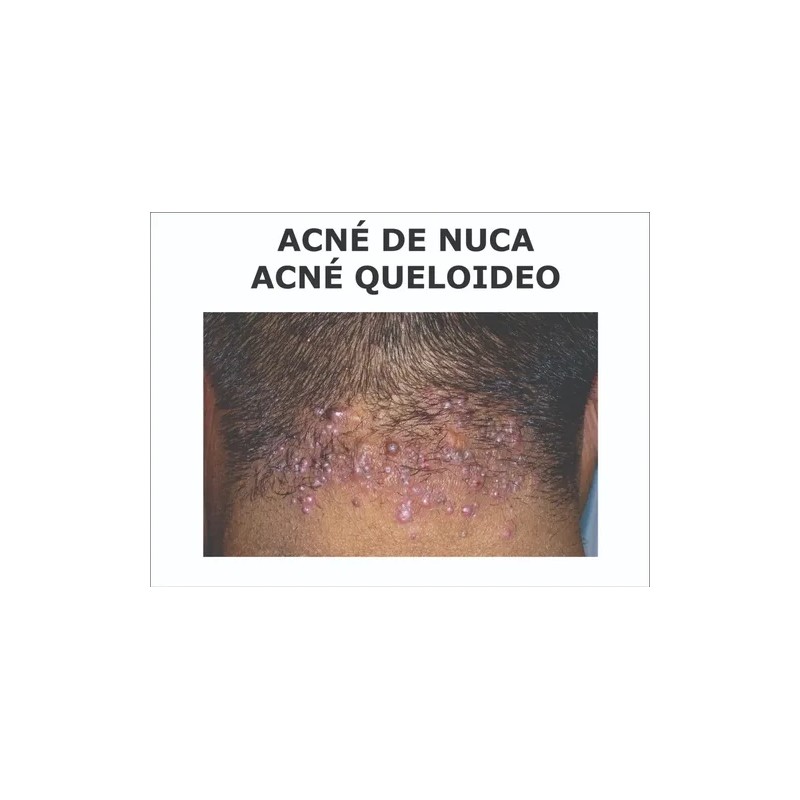 Boxi Tratamiento Para Acné Queloideo De Nuca 120 G